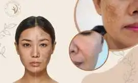 Expert Hyperpigmentation Care – Aafiyat Advanced A, Mississauga