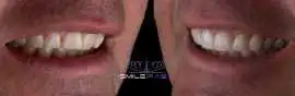 Same Day Teeth Implants – Walk Out with New Fixed , Bromley