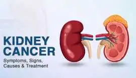 Kidney Cancer Treatments in Bangalore  , Bengaluru