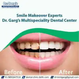 Smile Makeover Experts | Dr. Garg’s Dental Center, New Delhi