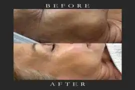 Pigmentation Peel in West Kensington, London, London