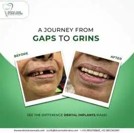 Painless Dental Fillings in Noida, Noida