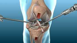knee ACL Ligament Surgery in Jaipur, Jaipur