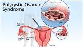 Find the Best PCOS Specialist in NYC, New York