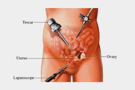 Treatment for Laparoscopic Hysterectomy in Ahmedab, Ahmedabad
