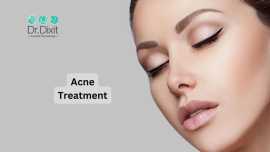 Acne Treatment In Bangalore, Bengaluru