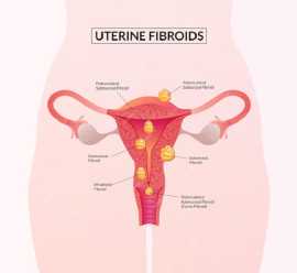Get Consultation on Uterine Fibroid in Ahmedabad, Ahmedabad