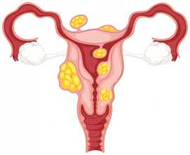 Most Experienced Adenomyosis Specialist Ahmedabad, Ahmedabad