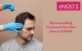 Advanced Micro needling treatment at Anoos, Hyderabad
