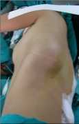 Chest Wall Tumor Treatment In Delhi, New Delhi