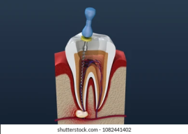 Root Canal Treatment In Delhi , New Delhi