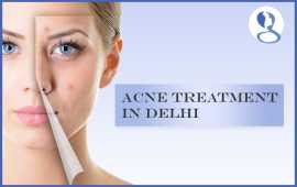 Acne Treatment in Delhi | Dr Sandeep Arora, New Delhi
