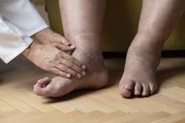 diabetic foot ulcer treatment in india, Hyderabad