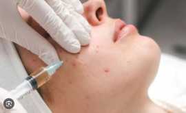 Acne Scar Treatment Birmingham, Sutton Coldfield