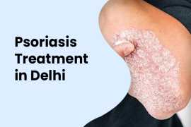 Effective Psoriasis Treatment in Delhi for Healthy, New Delhi