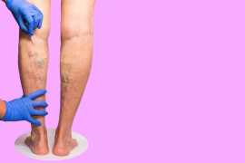 What to Expect at a Vein Clinic?, Lindenhurst