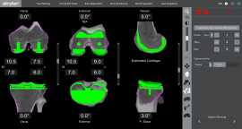 Robotic Knee Replacement Surgery, Melbourne