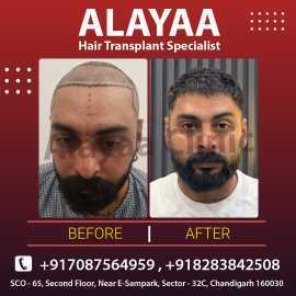 Guide to Latest Techniques, Best Hair Transplant C, Chandigarh