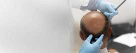 BIO FUE Hair Transplant in Mumbai, Mumbai
