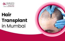 Hair Transplant in Mumbai, Mumbai