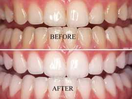 Experience the Best Teeth Whitening Services, Campbell