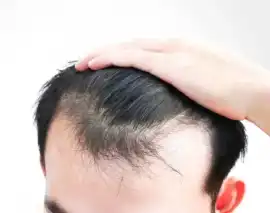 Get FUE Hair Transplant in Gurgaon, Gurgaon