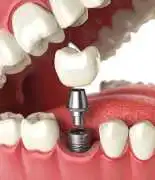 Experience the Best Teeth Whitening NYC Has to Off, New York