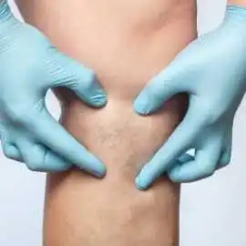 Effective Spider Veins Treatments Fort Collins, Fort Collins