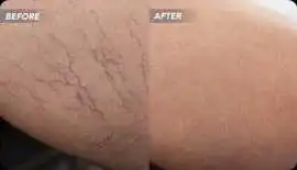 Does spider vein removal really work?, San Diego