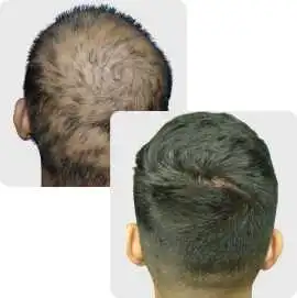 Regrow Confidence with Hair Replacement Perth, Subiaco