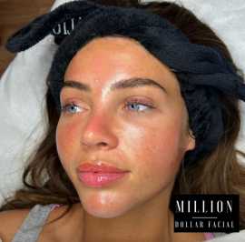 Million dollar facial , London