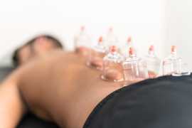 Cupping Therapy in San Francisco, San Francisco