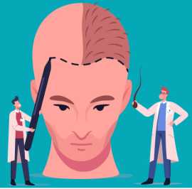 Best Hair Loss Treatment for Men w/ IHLS Australia, Subiaco
