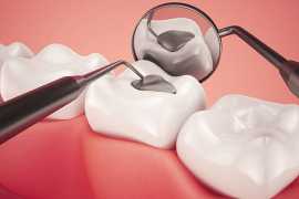 Dental Fillings In Delhi At Kamal Dental Clinic, New Delhi