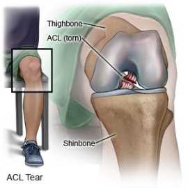 Top-Rated ACL Ligament Surgery in Jaipu, Jaipur