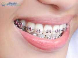 Unlock Your Perfect Smile : Orthodontic Treatment , Ahmedabad