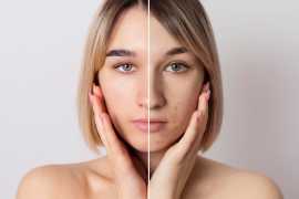 Acne Scars Treatment in San Francisco, San Francisco
