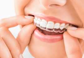 The Complete Guide to Invisalign Dental Treatment , Hayward