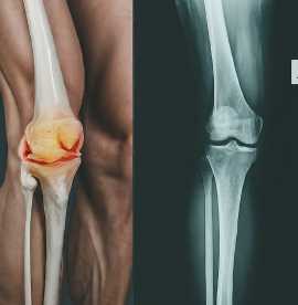 Keeping Active: Common Orthopaedic Conditions in S, Yishun New Town