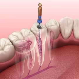 Kamal Dental Clinic -Root Canal Treatment In Delhi, New Delhi