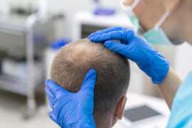 Permanent Hair Transplant Cost in Rajasthan, Jaipur