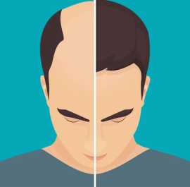  Best Hair Loss and Hair Regrowth Treatment Perth, Subiaco