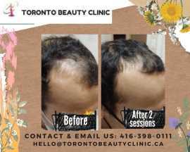 PRP for Hair Transplant Recovery – Improve Density, Toronto