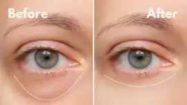 Best eye cream for puffy eyes, Delhi