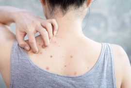 Effective Bacne Scars Treatment in Singapore, Bukit Timah