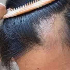best Hair doctor in Kota, Jaipur