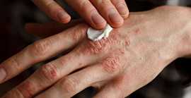 Eczema Treatment in Delhi, Delhi