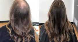 Search for the Best Hair Regrowth Treatment Birmin, Sutton Coldfield