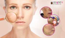 Laser Treatment for Pigmentation in Bangalore, Bengaluru