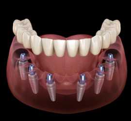 Restore Your Smile with Confidence: Dental Implant, Euless